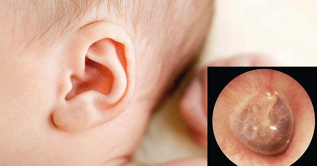 Nhiễm trùng tai giữa là bệnh lý ở trẻ em tương đối phổ biến