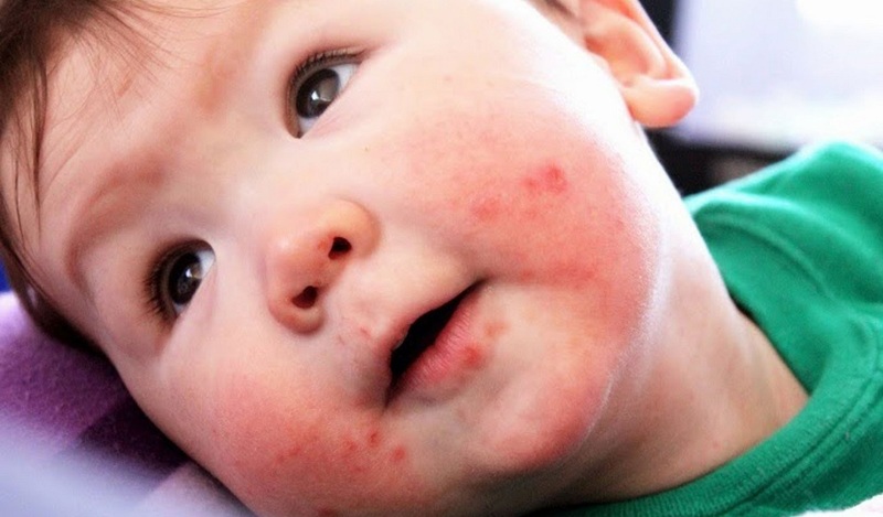 Trẻ bị ban đỏ nhiễm khuẩn cấp ở hai bên má