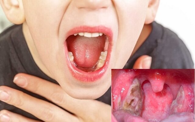 Bệnh chân tay miệng ở trẻ em dễ nhầm lẫn sang các bệnh khác