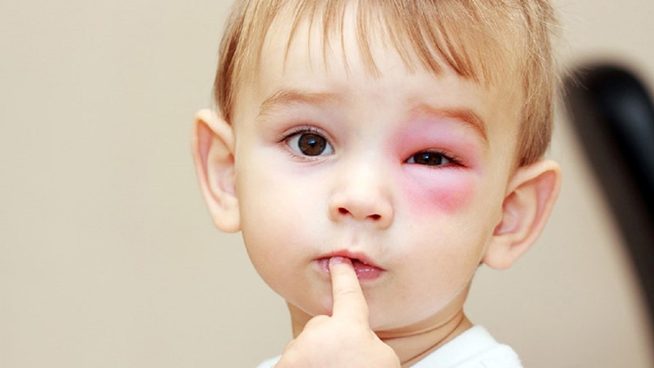 Trẻ bị bệnh đau mắt đỏ